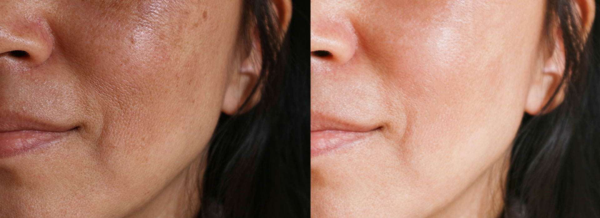 Resultado antes e depois de tratamento de melasma