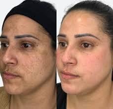 Resultado antes e depois de clareamento de manchas